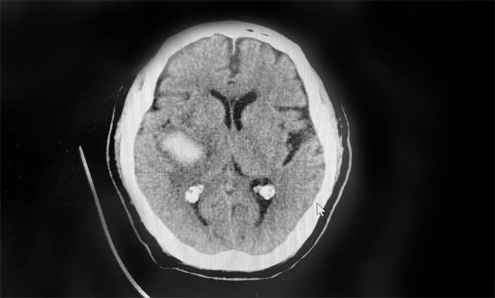 优质服务 ︱ 抓住脑出血后“黄金康复期” 精心救治助患者恢复行走能力